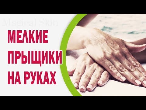 Мелкие прыщики на руках: причины появления, лечение, профилактика