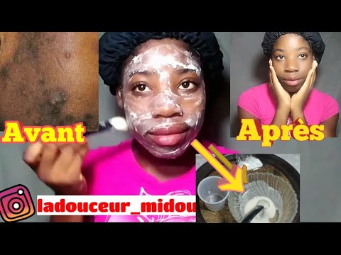 Vidéo: Comment Guérir Un Visage Meurtri: Traitements Médicaux Et Remèdes Maison