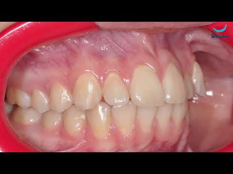 Короткая уздечка языка. Догару А. М. Клиника Dr. Smile