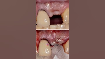 Ossix Volumax to augment facial surface and tissue ingrowth during dental implant placement