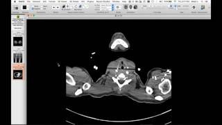 STR Cardiothoracic Web Case Conference 8/25/2016
