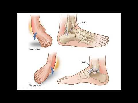 ตำราความเจ็บปวด เรื่อง ข้อเคล็ด ข้อแพลง sprain