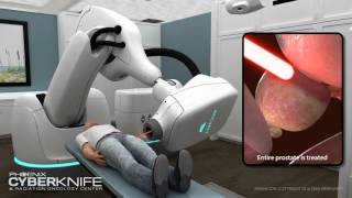 CyberKnife Prostate Tumor Animation