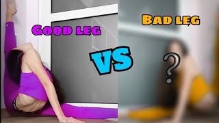 Good leg VS Bad leg | VesiContortion |