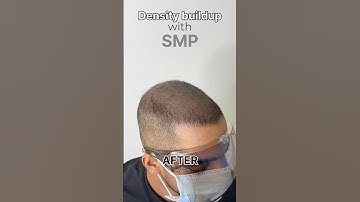 Scalp micropigmentation for thin hair #scalpmicropigmentation #smp