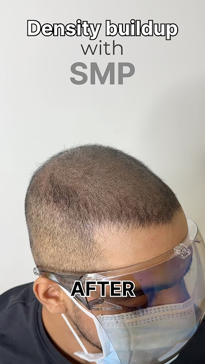 Scalp micropigmentation for thin hair #scalpmicropigmentation #smp