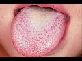  6 traitement naturel pour la langue blanche 