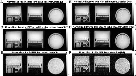 Myelin Imaging Using 3D Dual-echo Ultra-short Echo Time MRI with Rosette k-Space Pattern