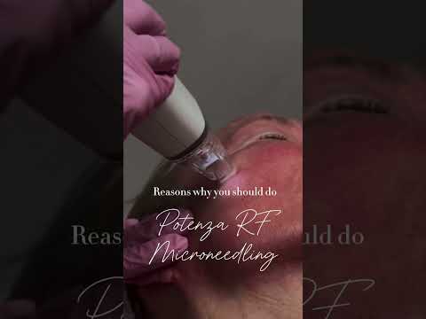 Potenza Microneedling Treatment