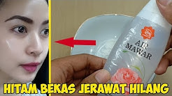 Cara Menghilangkan Bekas Jerawat dalam 5 Menit, Noda Hitam di Wajah Luntur Seketika cuy!!! - Durasi: 3.13. 