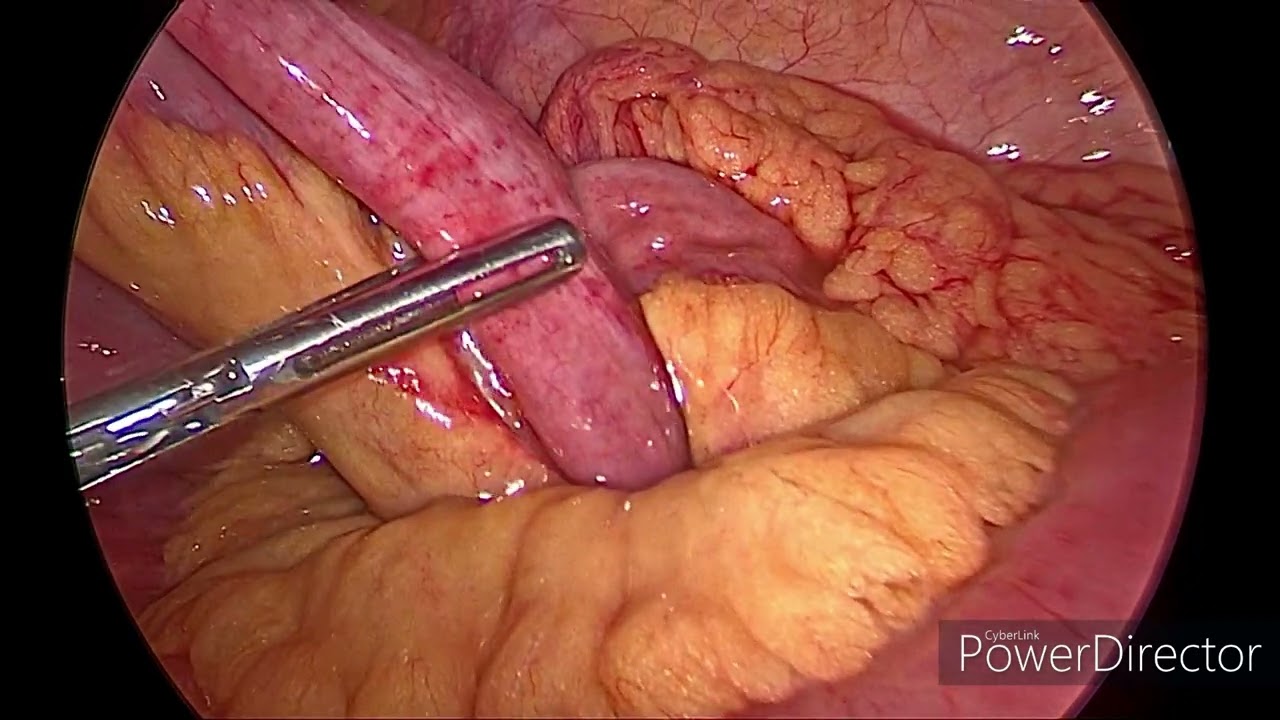 laparoscopic band release for intestinal obstruction