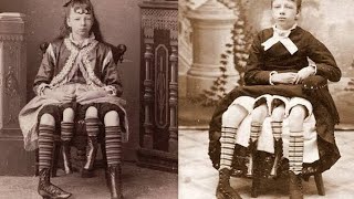 Myrtle Corbin Who Got Married With Two S And Four Legs Dipygus Deformity