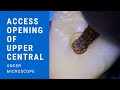 Access opening of upper central incisor under microscope  aspire32