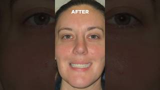 What an incredible transformation Amanda, congrats! #smiledentist #dentalimplants #beforeandafter