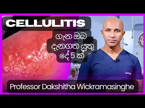 Cellulitis (සෙලියුලයිටිස්) ගැන ඔබ දැනගතයුතු දේ 5ක් - මහාචාර්ය දක්ෂිත වික්‍රමසිංහ