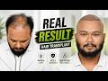 Hair Transplant in Patna (HX-ZQAD) | Best Results & Cost of Hair Transplant in Patna.
