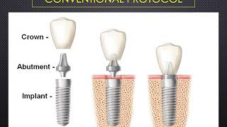 IMPL538 - Treatment planning and consideration for implants from a surgical aspect