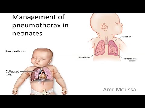 Management of pneumothorax in newborn.. Dr. Amr Moussa