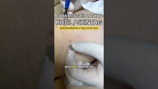 How To Remove Warts And Skin Tags Quickly And Easily Cauterization At Seira Clinic Solo