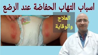 اسباب التهاب الحفاضة عند الرضع .. العلاج والوقاية من تسلخات الحفاضة عند الاطفال الرضع