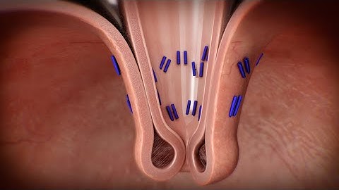 Transoral Incisionless Fundoplication (TIF) Procedure