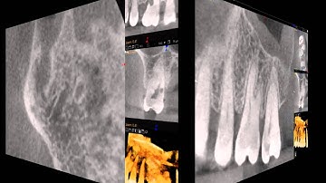 CBCT of external resorption in an upper molar