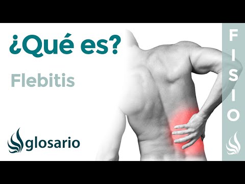 Vídeo: Flebitis: Síntomas, Causas, Prevención Y Más