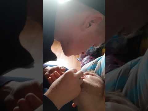 Как можно снять швы с губы