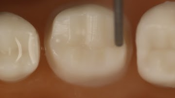 PFM Crown Posterior Tooth Preparation With Metal Occlusal