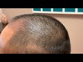 Dallas FUE Hair Transplant Testimonial One Day Out