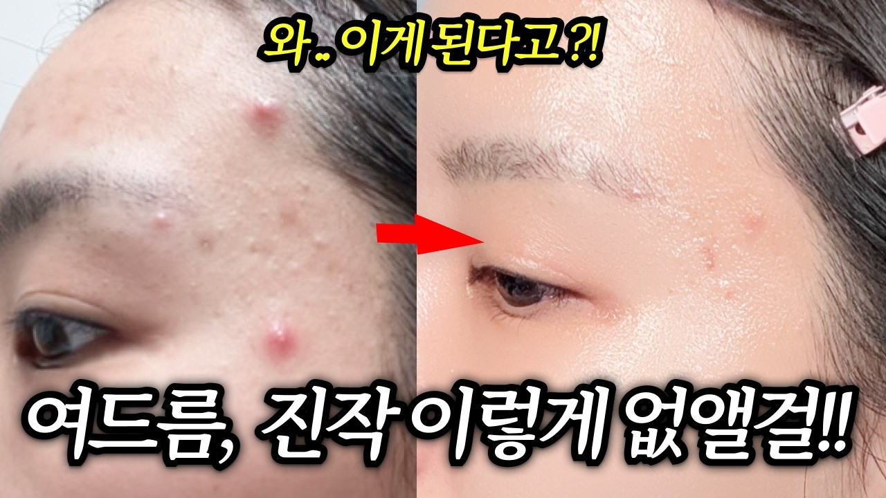 지긋지긋한 여드름! 스킨케어만 제대로 해도 피부 좋아집니다!  (클렌징,스킨케어루틴,각질)