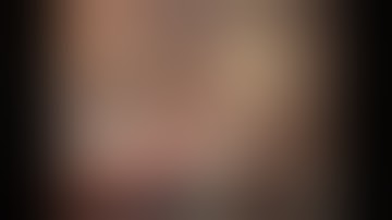 Liver resection for HCC, robotic left lateral segment