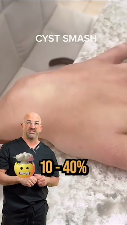 Popping Ganglion Cyst 🥈 #shorts