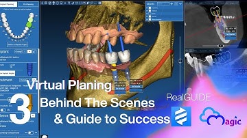 RealGUIDE Implant Planning Episode 3 تعلم تخطيط زراعة الاسنان من A to Z خطوة بخطوة