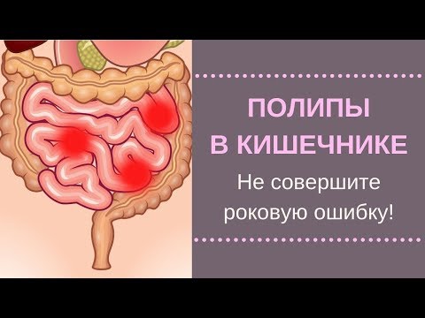 🔥Полипы В Кишечнике. Нашли полипы при колоноскопии. Как не совершить ошибку