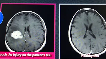 ¿Qué significa que una resonancia magnética muestre manchas blancas en el cerebro?