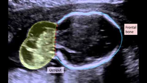 Encephalocele3