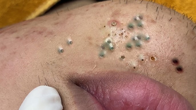 Blackheads & Acne Treatment 14.05.2024 (Part 8) #blackhead #whitehead #acne #blackheadremoval - YouTube
