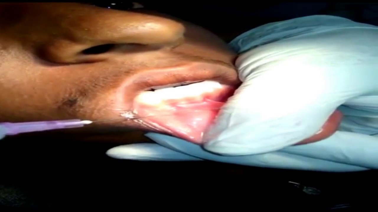 Mucocele removal 