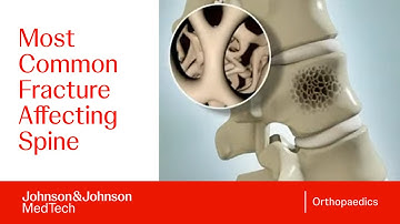 Wat is een wervelcompressiefractuur? Belangrijkste oorzaken en behandeling uitgelegd | J&J MedTech