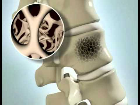 वर्टेब्रल संपीड़न फ्रैक्चर - DePuy Videos