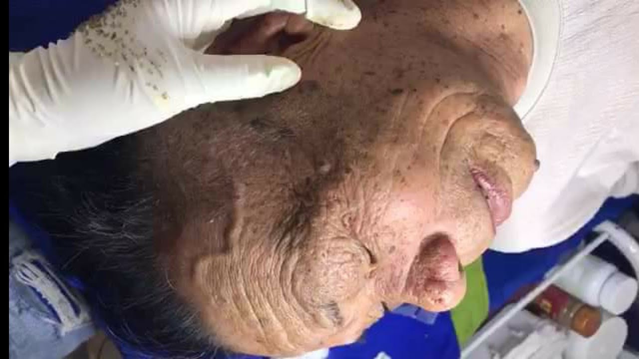 Many blackheads of his old (87 year old). I'm sorry, the quality is a bit low