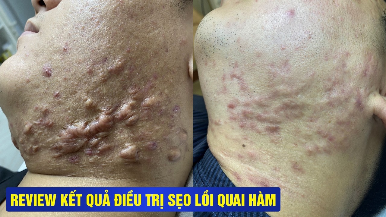 DU HỌC SINH CANADA VỀ VIỆT NAM ĐIỀU TRỊ SẸO LỒI SAU 1 BUỔI - SẸO GIẢM ĐẾN 50%