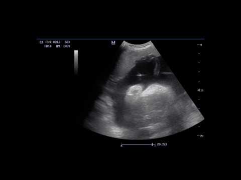 კორდოცენტეზი / CORDOCENTESIS