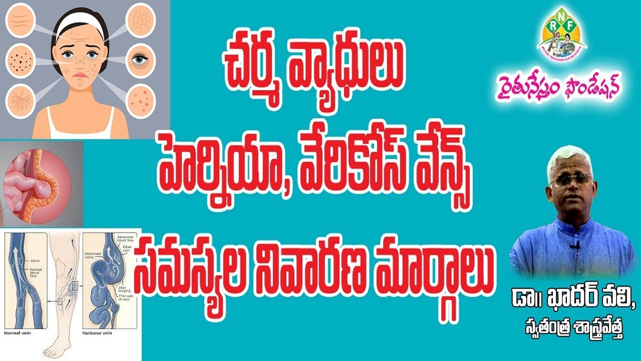 Preventive Measures for Skin, Hernia, varicose veins Problems || Dr. Khader valli