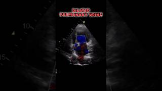 Top 5 Causes of Dilated Pulmonary Veins on Echo #heart #echocardiography