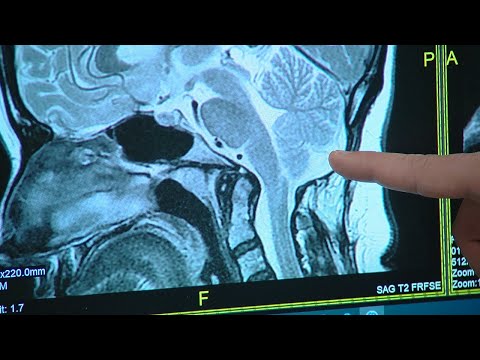 Local woman finds reason behind painful headaches after years of suffering