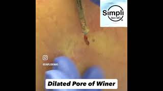 Dilated Pore Of Winer Extraction