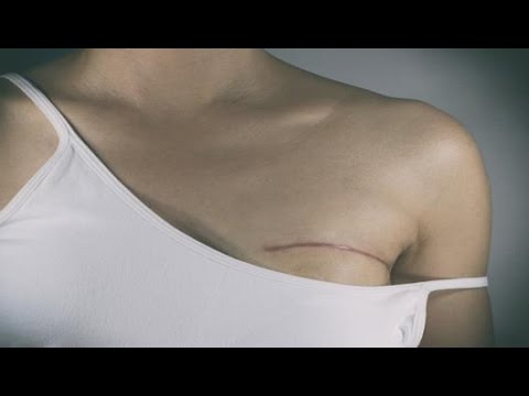Video: Rökning Och Risk För Bröstcancer I Generations Study-kohorten