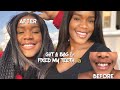 I Closed My Gaps With Composite Bonding In Two Hours Only! | Vlog Style | Tashana Cole
